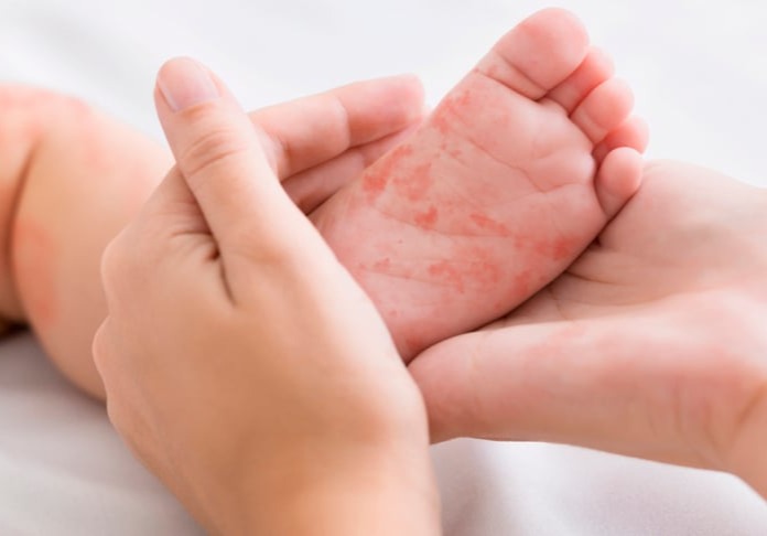 Διάγνωση και Αντιμετώπιση Ατοπικής Δερματίτιδας, Εκζέματος